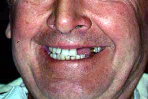 bridges_3teeth1