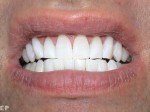 new-enlighten-whitening-work-completed