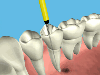 root_canal_endo1