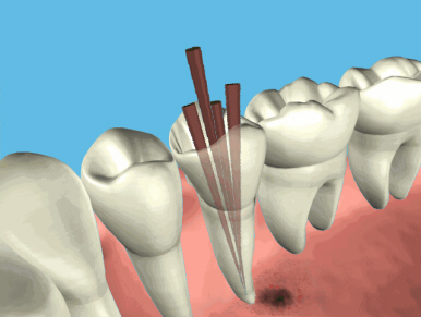 root_canal_endo2
