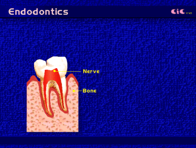 root_canal_endod1
