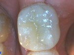 tooth_coloured_inlay