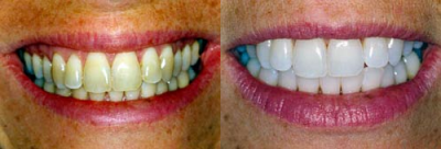 tooth whitening coupon
